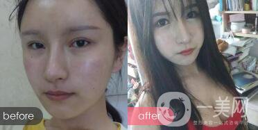 成都開(kāi)眼角多少錢(qián)呢？開(kāi)眼角案例