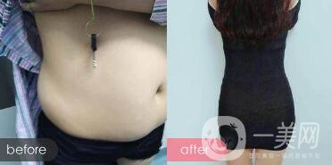 成都抽脂減肥價(jià)格多少?成都抽全身脂要多少錢?