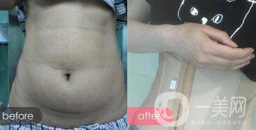 成都抽脂減肥價(jià)格多少?成都抽全身脂要多少錢?