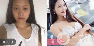 隆胸手術(shù)該如何選擇假體大小?