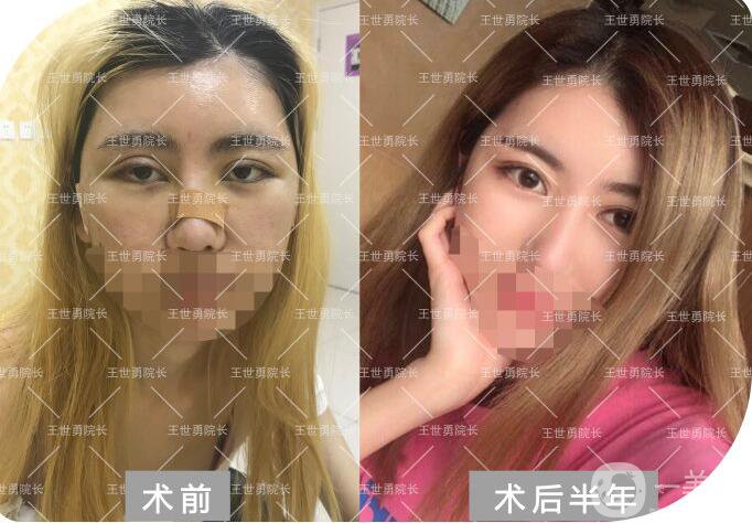 北京雙眼皮修復(fù)