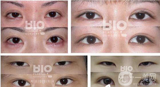 北京雙眼皮修復(fù)