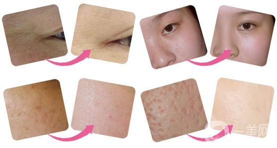 光子嫩膚后注意事項(xiàng) 多久做一次呢