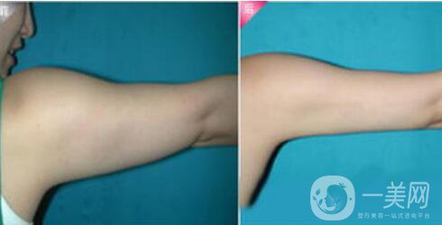 成都抽脂減肥價(jià)格多少