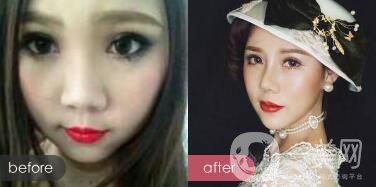 *手術(shù)恢復(fù)多久？多久可以拆線？