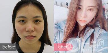 *手術(shù)恢復(fù)多久？多久可以拆線？