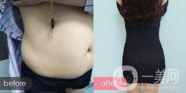 韓式共振吸脂減肥