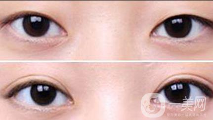 不開刀的雙眼皮