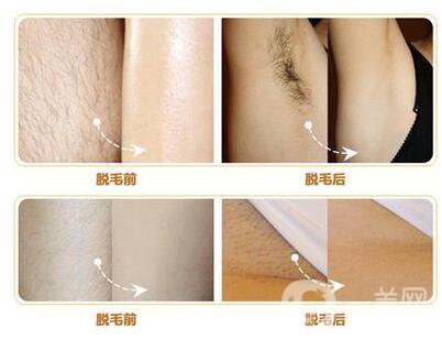 什么是激光脫毛？激光脫毛的優(yōu)勢有哪些？