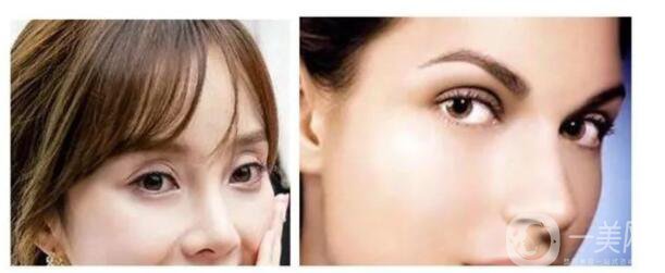 歐式雙眼皮手術(shù)適合哪些人呀 多少錢