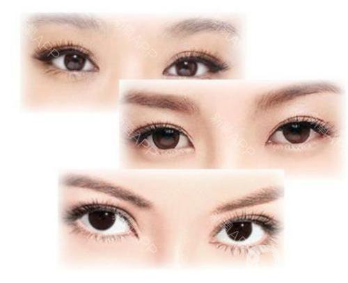 歐式雙眼皮手術(shù)適合哪些人呀 多少錢