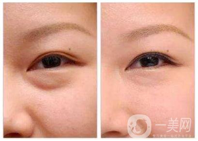 激光去眼袋痛不痛 調(diào)節(jié)原理是什么