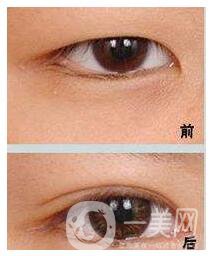 割雙眼皮多少錢合適 影響價(jià)格的因素有哪些