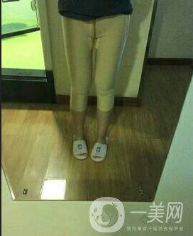 水動(dòng)力吸脂親身經(jīng)歷