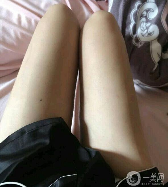 水動(dòng)力吸脂親身經(jīng)歷