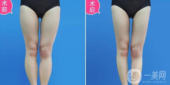 北京抽脂多少錢