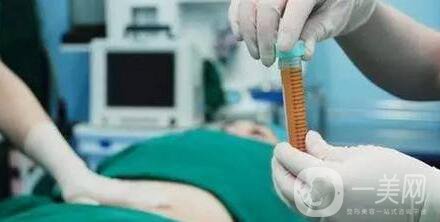 自體脂肪移植注意事項(xiàng)