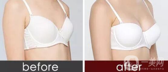假體隆胸,水滴形假體,圓形假體