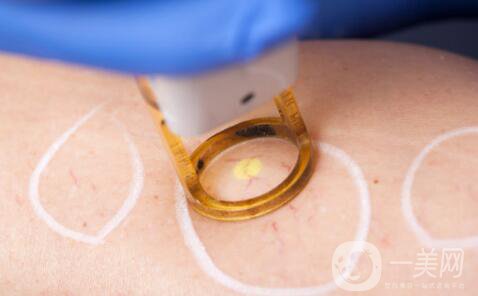 光電美容項(xiàng)目