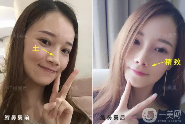 鼻翼縮窄多少錢