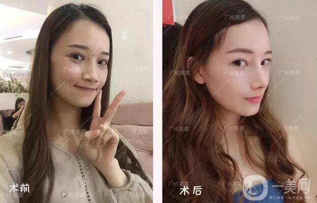 縮鼻翼手術(shù)