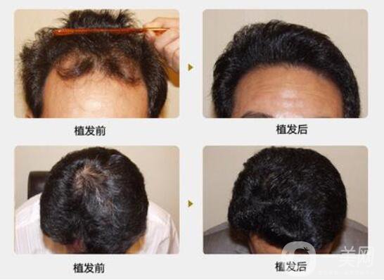 什么是植發(fā)手術(shù)？脫發(fā)的主要原因？