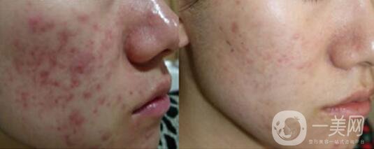 黑臉娃娃去痘*果好不好