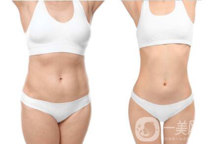 360度環(huán)形吸脂要多少錢呀