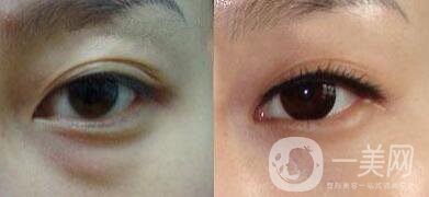 內(nèi)吸去眼袋價格