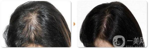 廣州雍和頭發(fā)種植手術(shù)要多少錢