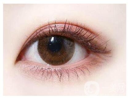 切開雙眼皮適合人群有哪些呢？