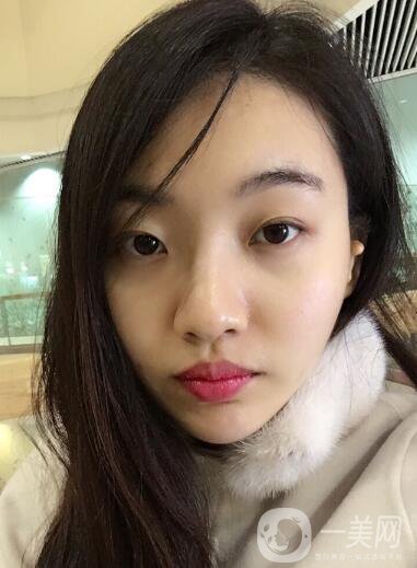 成都等離子光纖溶脂