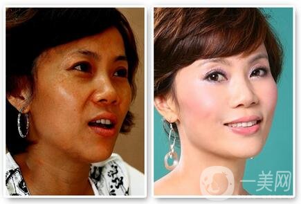 彩光嫩膚*嗎？對人體有害嗎？