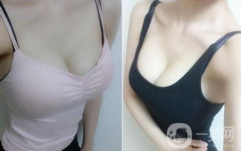 假體隆胸術有哪些特點？