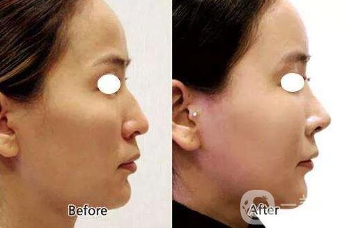 瑞蘭玻尿酸隆鼻價(jià)格多少錢？貴嗎？