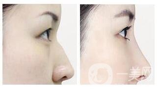 北京隆鼻價格大概是多少錢?