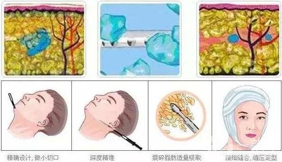 光纖溶脂瘦臉多久恢復(fù)?恢復(fù)期要注意什么?