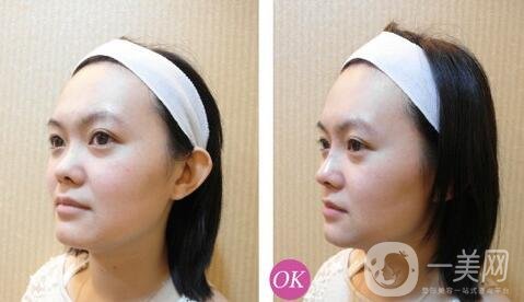 隆高鼻梁會不會肉不夠?醫(yī)生是怎么做的?