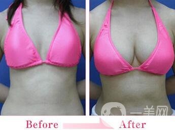 假體隆胸的技術(shù)目前已經(jīng)比較成熟，有些愛美的女士在胸部位置，想要借助假體，來擴大胸部的*果。 為了讓自己能夠突出獨特象征的身材，想到的方法就是選擇進行假體隆胸手術(shù)，通過做假體隆胸手術(shù)，可以讓我們擁有傲人的身姿。毛面隆胸假體外層有組紋，有種磨砂的手感，它的其在特點是可允許組織粘在表面，這樣*降低包膜縮小的可能，其中相對價格比其他的貴一些。