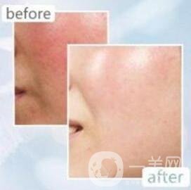 光子去紅血絲多久見*?恢復(fù)過程是怎樣的?