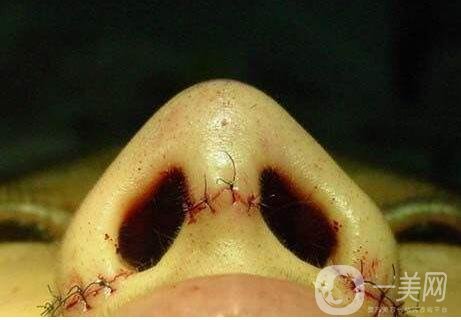 內(nèi)切鼻翼縮小多久才能恢復(fù)？是否會(huì)留下疤痕？