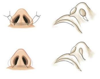 內(nèi)切鼻翼縮小多久才能恢復(fù)？是否會(huì)留下疤痕？