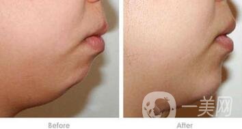 硅膠墊下巴排異癥狀有哪些？怎樣才知道排異了？