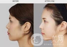 硅膠墊下巴要疼幾天？如何緩解這種疼痛感？