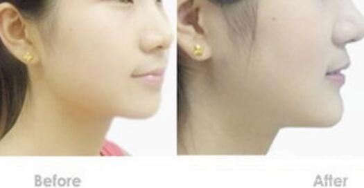 硅膠墊下巴硬得像石頭，多久能恢復？