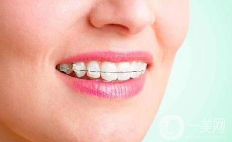 3m半隱形牙套價格多少錢?貴嗎?