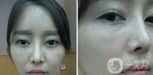 鼻整形修復(fù)手術(shù)