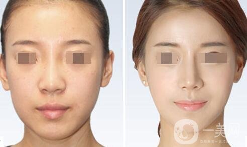 鼻翼縮小術(shù)