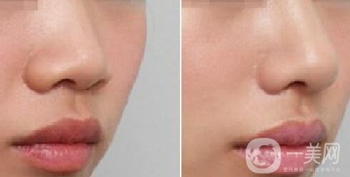 鼻翼縮小手術(shù)