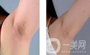 蜜蠟脫毛會(huì)越來越粗嗎？